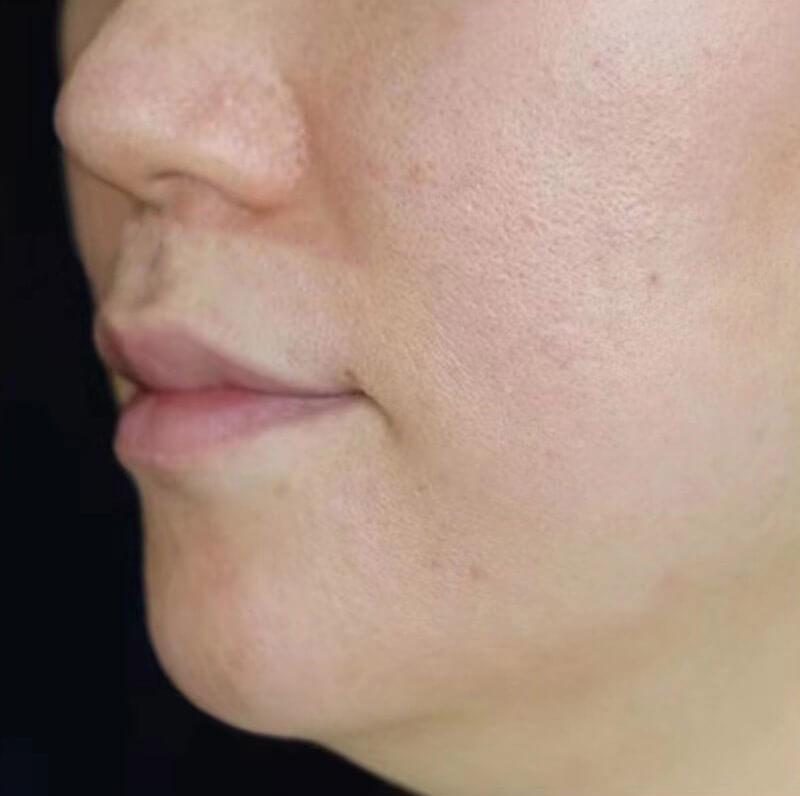 microneedling - after photo