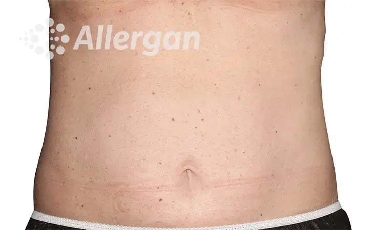 Coolsculpting, after treatment photo