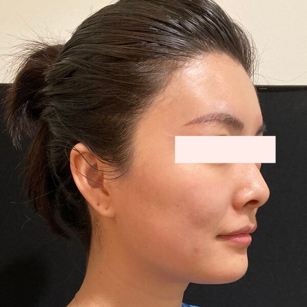 Thermage, after treatment photo