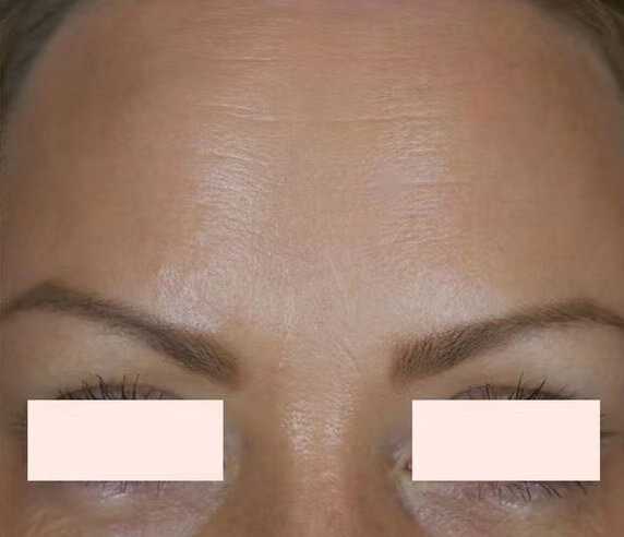 Xeomin, after treatment photo
