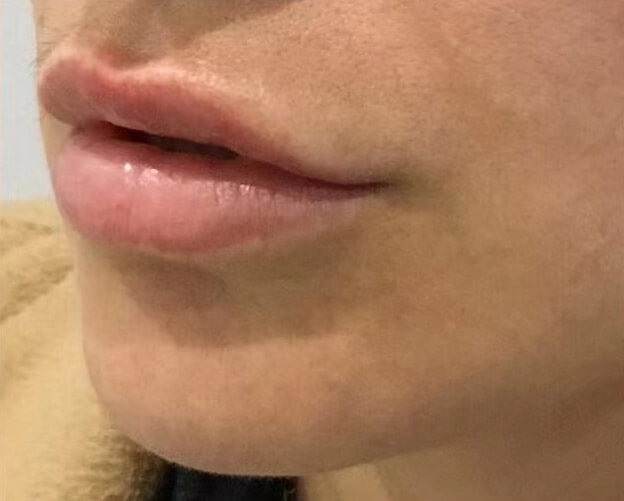 Lip filler, after treatment photo