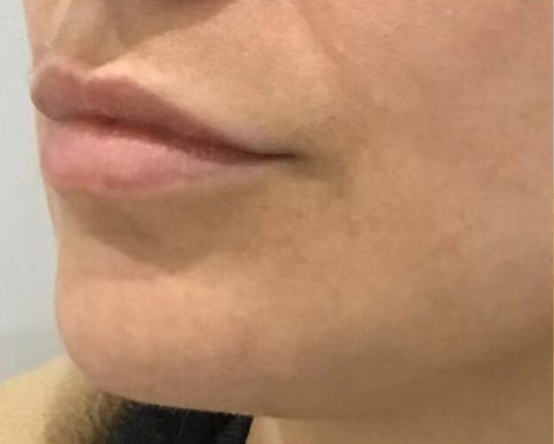 Lip filler, before treatment photo
